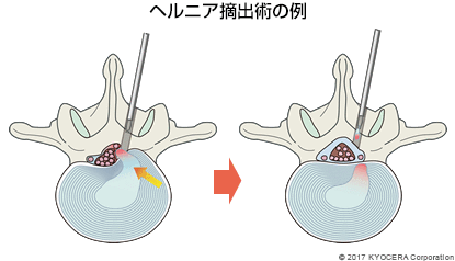 ヘルニア摘出術の例