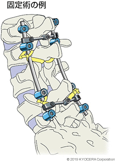 固定術の例