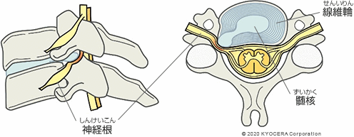 腰椎椎間板ヘルニア
