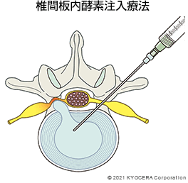 椎間板内酵素注入療法