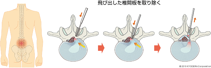 腰椎椎間板ヘルニア手術の例