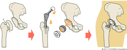 全人工股関節置換術の例