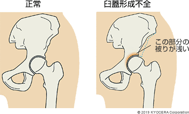 正常 臼蓋形成不全