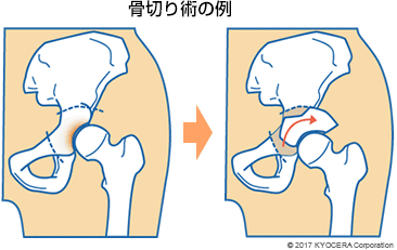 骨切り術の例