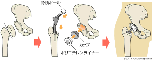 セメントレスタイプの人工股関節置換術の例