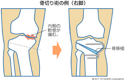 骨切り術の例（右脚）