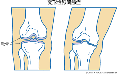 変形性膝関節症