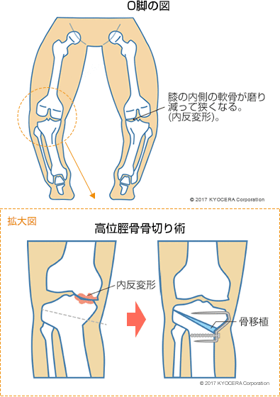 O脚の図 高位脛骨骨切り術