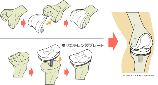 人工膝関節全置換術の例