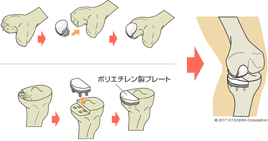 人工膝関節単顆置換術の例