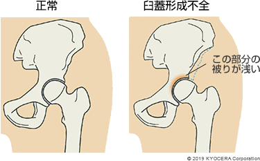 正常 臼蓋形成不全