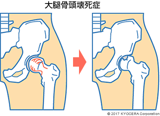 大腿骨頭壊死症