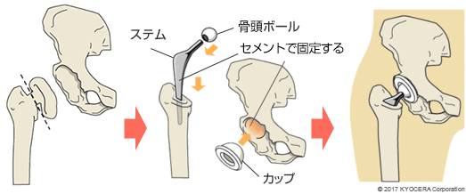 セメントタイプの人工股関節置換術の例