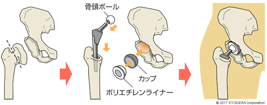 セメントレスタイプの人工股関節置換術の例