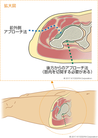 前外側アプローチ法 後方からのアプローチ法（筋肉を切開する必要がある）