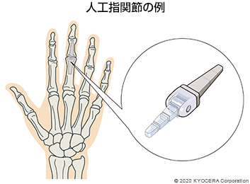 人工指関節の例