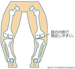 膝の内側で発症しやすい。