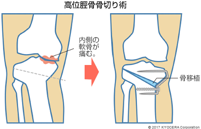 高位脛骨骨切り術