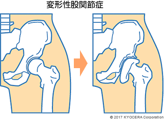 変形性股関節症