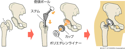 人工股関節置換術の例（後述するセメントレスタイプの場合）