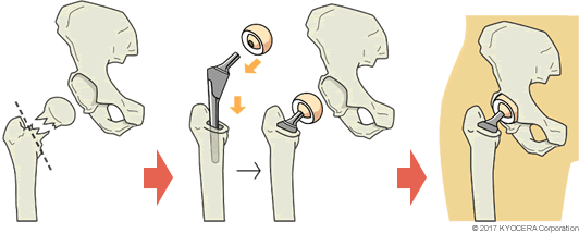 人工骨頭置換術（BHA）の例
