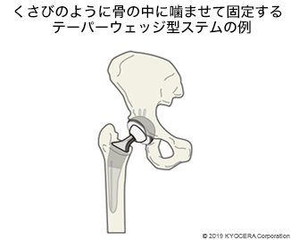 くさびのように骨の中に噛ませて固定するテーパーウェッジ型ステムの例