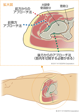 前方からのアプローチ法 前側方アプローチ法 後方からのアプローチ法（筋肉を切開する必要がある）