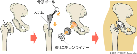 人工股関節置換術の例