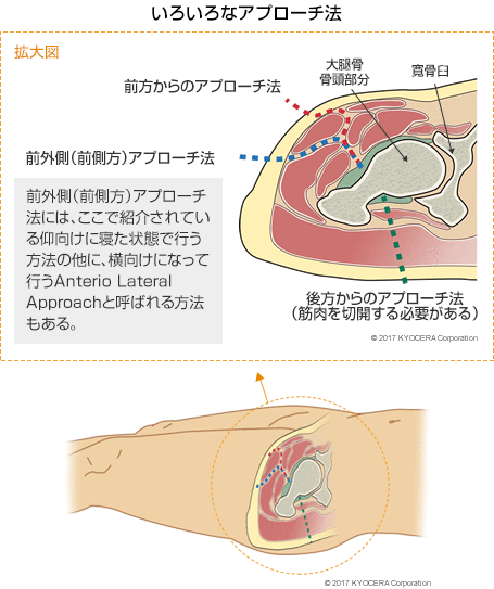 いろいろなアプローチ法