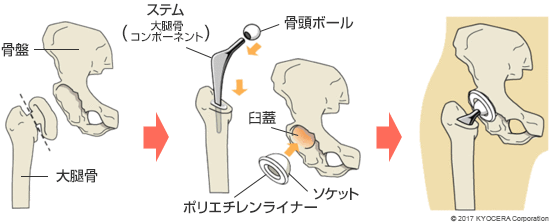 セメントタイプ人工股関節置換術の例