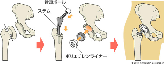 人工股関節置換術