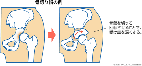 骨切り術の例