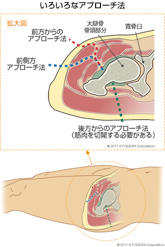 いろいろなアプローチ法