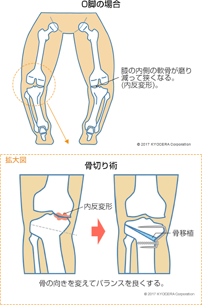 O脚の場合