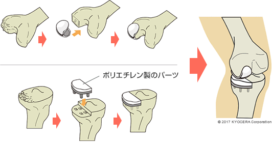 人工膝関節単顆置換術：UKA