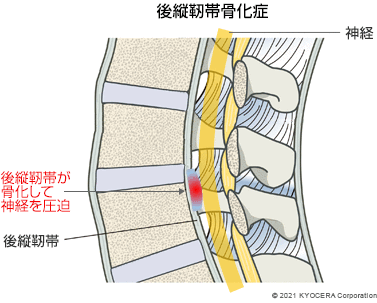 後縦靭帯骨化症