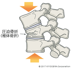 圧迫骨折（椎体骨折）