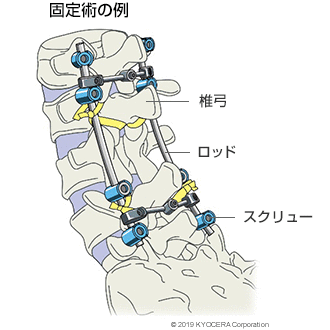 固定術の例