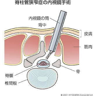 脊柱管狭窄症の内視鏡手術