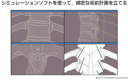 シミュレーションソフトを使って、綿密な術前計画を立てる