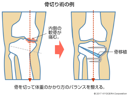 骨切り術の例