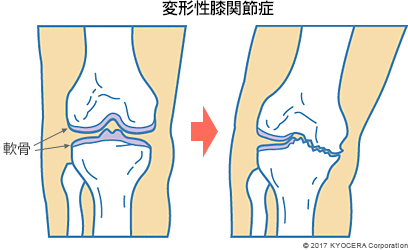 変形性膝関節症