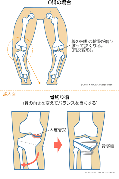 O脚の場合 骨切り術(骨の向きを変えてバランスを良くする)