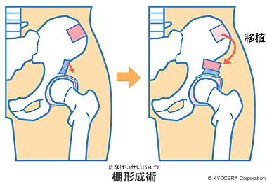 棚形成術