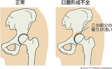 正常 臼蓋形成不全