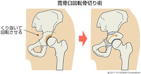 寛骨臼回転骨切り術