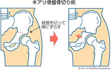 キアリ骨盤骨切り術