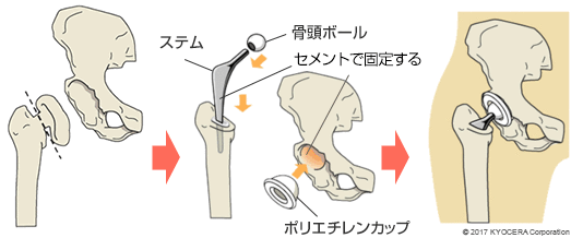 セメントタイプの人工股関節置換術の例