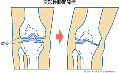 変形性膝関節症