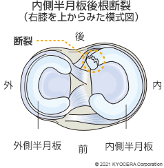 内側半月板後根断裂（右膝を上からみた模式図）